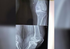 Knee arthroplasty