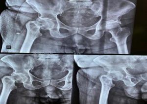 Hip Injury