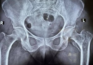 Best Hip Replacement